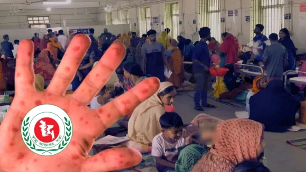 সিলেটে হামের উপসর্গে একদিনে চার শিশুর মৃত্যু, মোট মৃত্যু ৫১